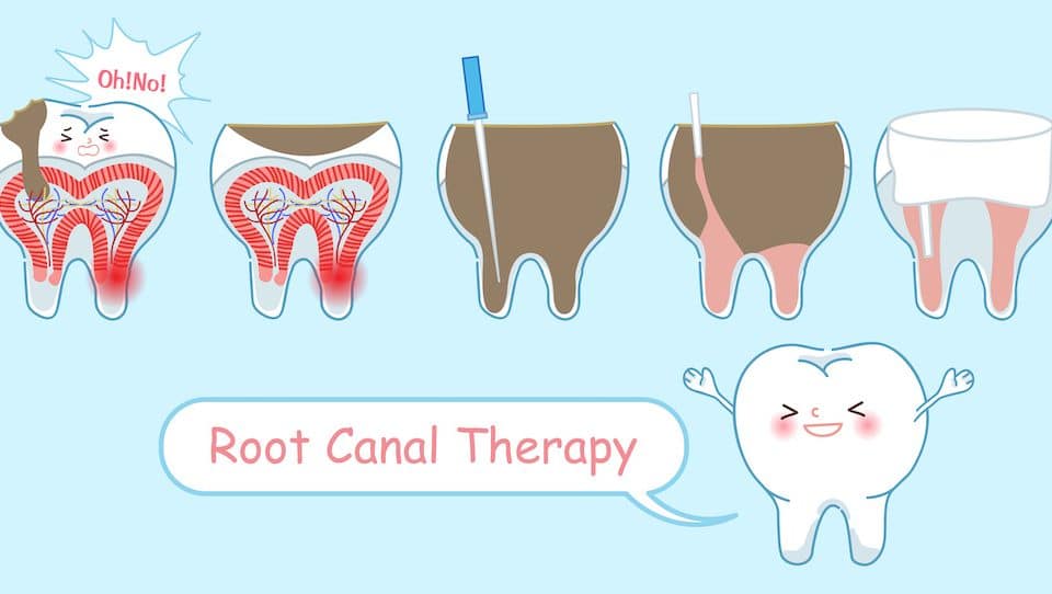 Root Canal Awareness Week: What You Should Know